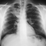 Image F. 10/01/05 FEV1=2.6.RAST=30.Rx Prednisolone- 2 weeks  and long term itraconazole 