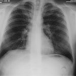 Image G. 07/02/05 FEV1=2.8 on Itraconazole.