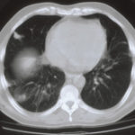 Image D. CT scan -major improvement (22 April)