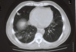 Image D. CT scan -major improvement (22 April)