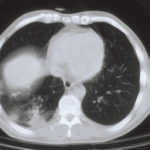 Image C. CTscan, RLL consolidation, behind the diaphragm (2 Feb)