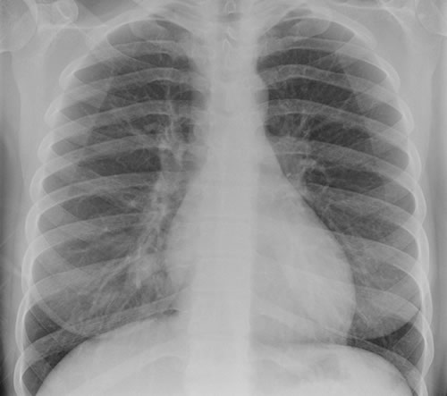 Image E. Chest X ray 1 (cf CT scan 1) one week pre-admission