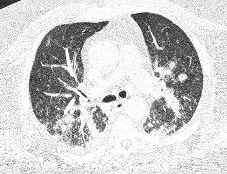 Image B. CT scan 2, on admission