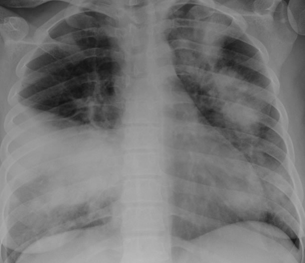 Image F. Chest X-ray 2 (cf CT Scan 2) on admission