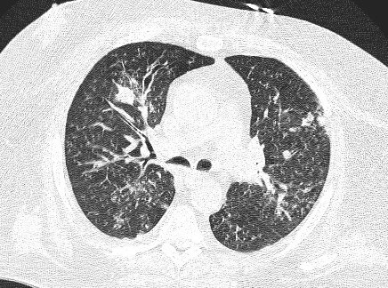 Image C. CT scan 3: Following 6 weeks antifungal treatment