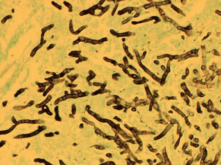 Image H. Histology stained with GMS stain showing septate branching hyphae