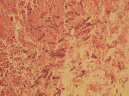 Image G. Histology (H&E) of membranous material removed on bronchoscopy