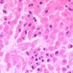 Image G. Sheets of eosinophils 