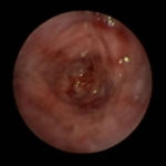 Image B. Bronchoscopy