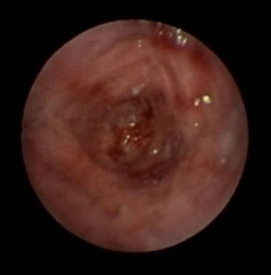 Image B. Bronchoscopy