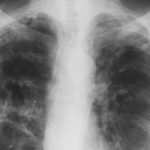 December 2002 - haemoptysis and continuing respiratory problems and weight loss (38Kg)