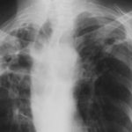 April 2004 - substantially improved, despite inter-current chest infections