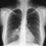 Image H. 14/02/03 Further exacerbation in right lower lobe