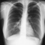 Image I. 21/02/03 some improvement after a week on corticosteroids