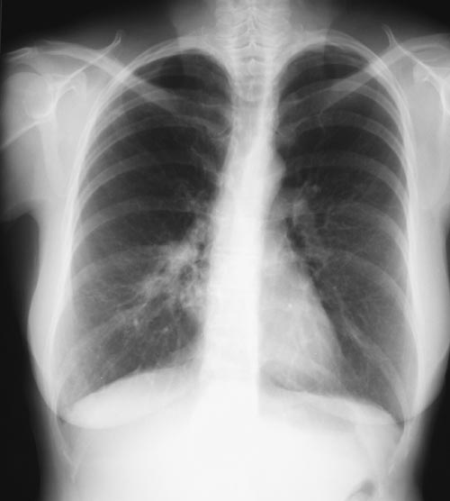 Image I. 21/02/03 some improvement after a week on corticosteroids