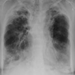 This chest radiograph shows widespread bronchiectatic with numerous small cavities at both apices of the lungs, with overlying pleural thickening and also additional changes at both bases. The transformation from ABPA is occasionally seen after many years of ABPA.