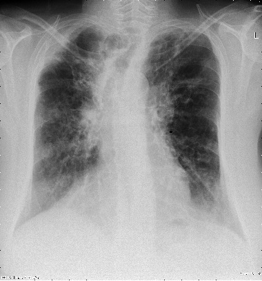 Image L. In late 2005, she deteriorated on itraconazole and was admitted to hospital for antibiotic therapy (12/2014)