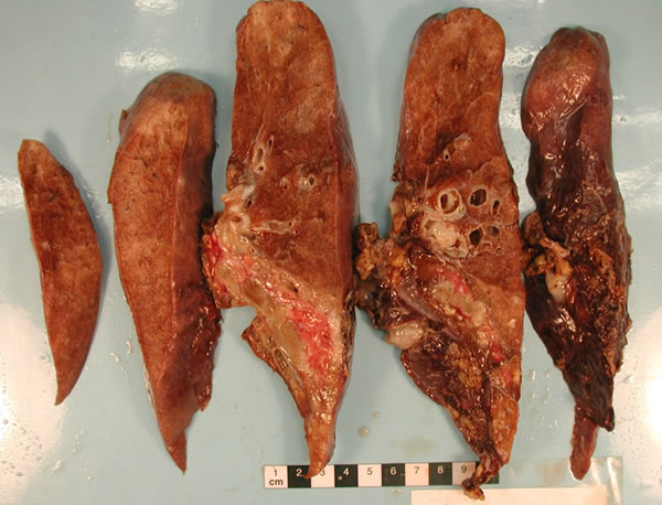 Image B. Macroscopic view of sliced left upper lobe of lung showing obstruction of lower segmental bronchi by impacted mucus.