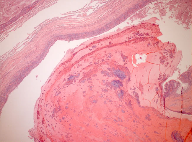 Image C. Low power microscopic view, haematoxylin and eosin staining, of obstructed bronchus with typical ‘laminated’ appearance – alternating layers of mucus and inflammatory cells.