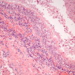 Image D. Higher power microscopic view, haematoxylin and eosin staining, showing goblet cell hyperplasia of bronchial epithelium and inflammatory infiltrate including numerous eosinophils