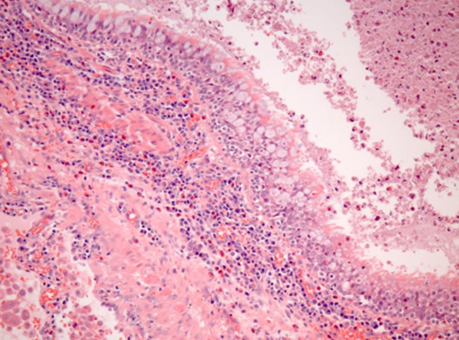Image D. Higher power microscopic view, haematoxylin and eosin staining, showing goblet cell hyperplasia of bronchial epithelium and inflammatory infiltrate including numerous eosinophils