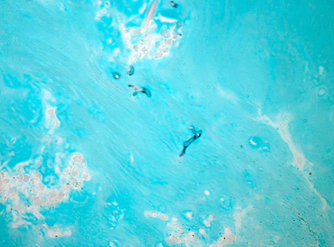 Image E. High power microscopic view, Grocott silver staining, showing scanty fungal hyphae in mucus. 