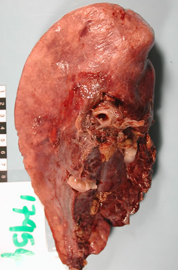 Image A. Macroscopic view medial aspect of left upper lobe of lung showing segmental collapse and congestion of lower segments, with mucus extruding from incised bronchi.