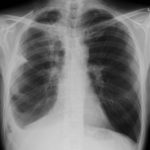 Image C. April 2009 – Post-operative chest x-ray showing post apical bullectomy on the right, resolved pneumothorax but the interval development of fluid in the right costo-phrenic angle with air fluid levels consistent with recent surgery.  Great reduction in apical bullae in the right apex but increasing consolidation proximally in the right upper zone and some fluid in the horizontal fissure.   These findings are following an apical bullectomy and pleurodesis of his prior significant pneumothorax.