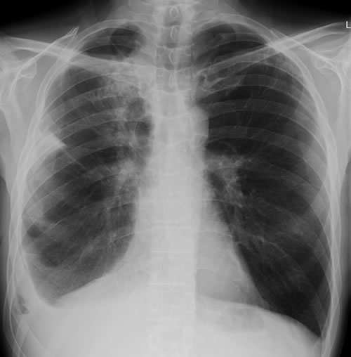 Image C. April 2009 – Post-operative chest x-ray showing post apical bullectomy on the right, resolved pneumothorax but the interval development of fluid in the right costo-phrenic angle with air fluid levels consistent with recent surgery.  Great reduction in apical bullae in the right apex but increasing consolidation proximally in the right upper zone and some fluid in the horizontal fissure.   These findings are following an apical bullectomy and pleurodesis of his prior significant pneumothorax.