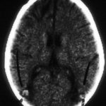Image B. CT scan of the brain more than 12 months after the diagnosis of cerebral aspergillosis was made, showing remarkable resolution of disease with daily amphotericin B and flucytosine, and continued chemotherapy for his leukaemia.