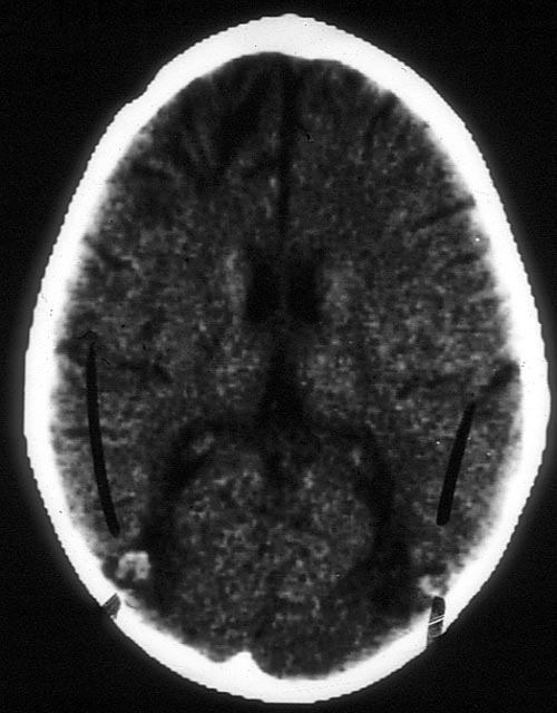 Image B. CT scan of the brain more than 12 months after the diagnosis of cerebral aspergillosis was made, showing remarkable resolution of disease with daily amphotericin B and flucytosine, and continued chemotherapy for his leukaemia.