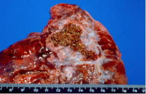 Apex, right lung. Notice pleural thickening, bronchiectasis, parenchymal fibrosis, and fungus ball within an old tuberculous cavern.