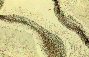 The luminal surface of the cavity covered with lamelliform hyphal growth (Grocott, x 100).