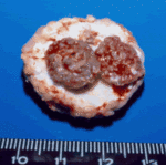 Multiple aspergillomas, Patient CR. Gross pathology showing three fungus balls in one cavity.