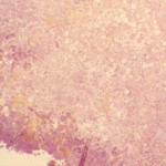 Cross section of specimen revealing vesicular swellings without viable hyphae.