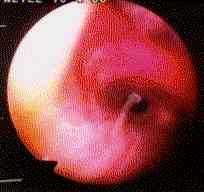 Image K. Bronchoscopy-Allergic Bronchopulmonary Aspergillosis (ABPA) 4/4/96