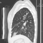 Fig 2 CT - Lateral view showing aspergilloma - left lower lobe. 