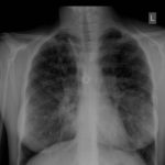 Fig 3 Chest X ray showing bilateral basal bronchiectasis with no definite aspergilloma.