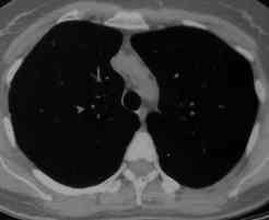 Image L. Allergic Bronchopulmonary Aspergillosis (ABPA) 2/7/96