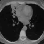 Image N. Allergic Bronchopulmonary Aspergillosis (ABPA) 2/7/96 