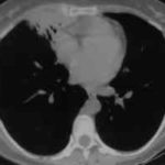Image O. Allergic Bronchopulmonary Aspergillosis (ABPA) 2/7/96 