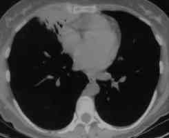 Image O. Allergic Bronchopulmonary Aspergillosis (ABPA) 2/7/96 