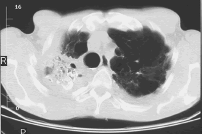 Image C. Scan after instillation of amphotericin B mixed with radiographic contrast medium showing debris surrounded by contrast, in an irregular large apicalcavity.