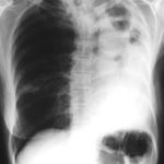 Image A. This plain chest x-ray showed two large cavities, one smaller cavity in the completely opacified left hemithorax, which contains fibrotic tissue.