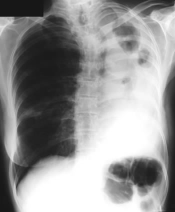 Image A. This plain chest x-ray showed two large cavities, one smaller cavity in the completely opacified left hemithorax, which contains fibrotic tissue.