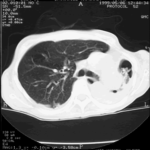 Image C CT scan of thorax with a section at the carina. 