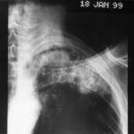 Image B. pt. DM Primary Aspergillus pneumonia (18.1.99)