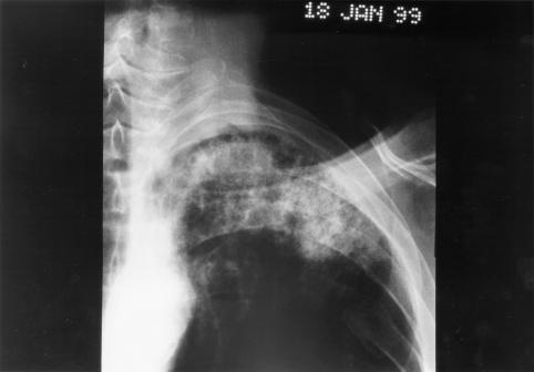 Image B. pt. DM Primary Aspergillus pneumonia (18.1.99)
