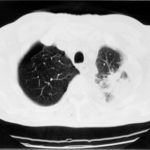 Image G. pt. DM CT scan of left apex (19.2.99)