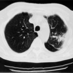 Image H. pt. DM CT scan of left apex (19.2.99). Primary Aspergillus pneumonia (with cavitation)